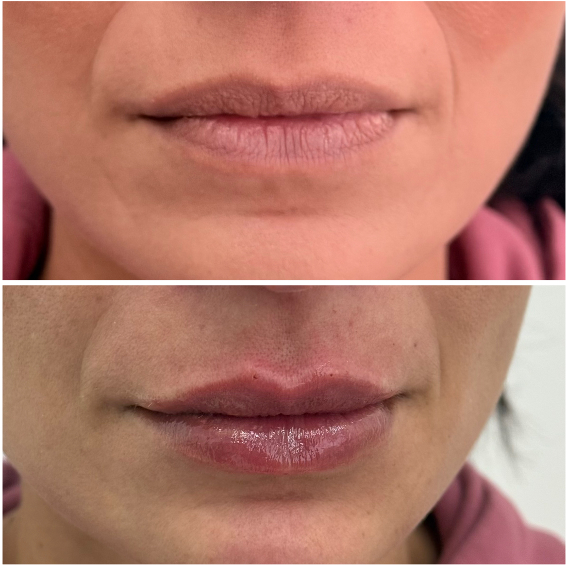 Antes e depois — Preenchimento labial