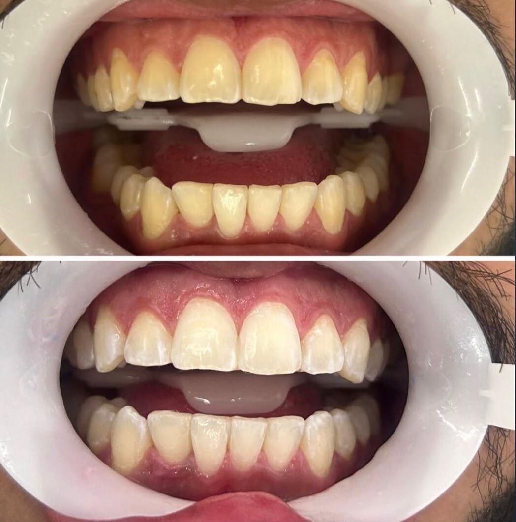 Antes e depois — Clareamento dental